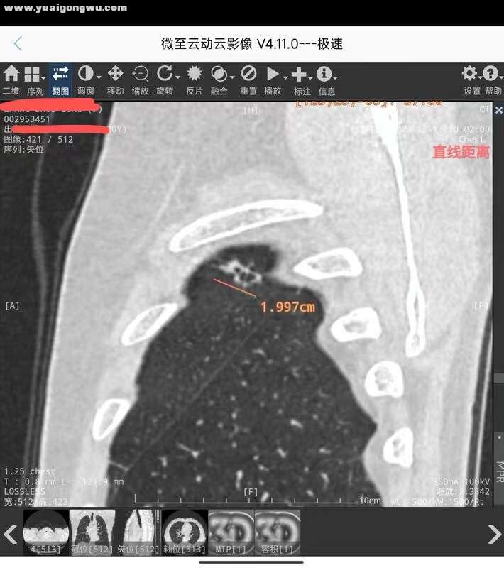 肺部高危结节4-5.jpg